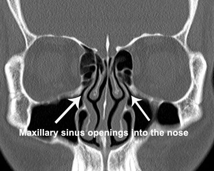 Why do I need CT scan for sinuses? - Dr S Sethi