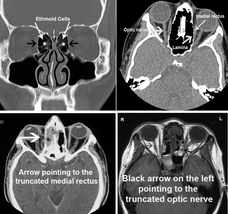 Endoscopic Sinus Surgery - Dr Dharambir S Sethi