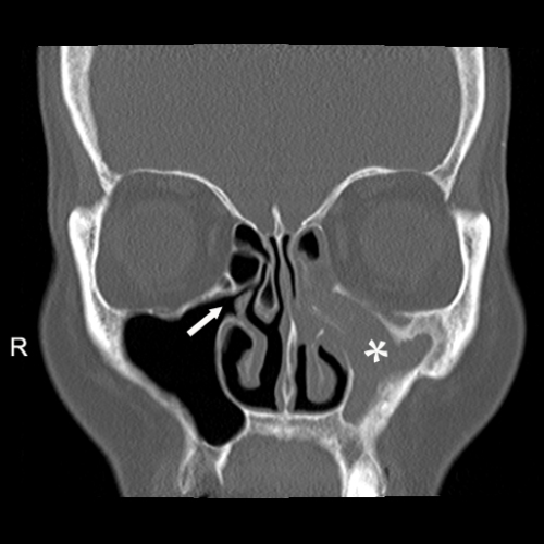 Sinusitis Dr Dharambir S Sethi